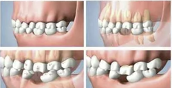 Протокол ортодонтического лечения тесного положения зубов